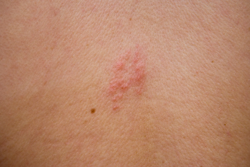 Close-up of bumps caused by shingles on a young woman's back